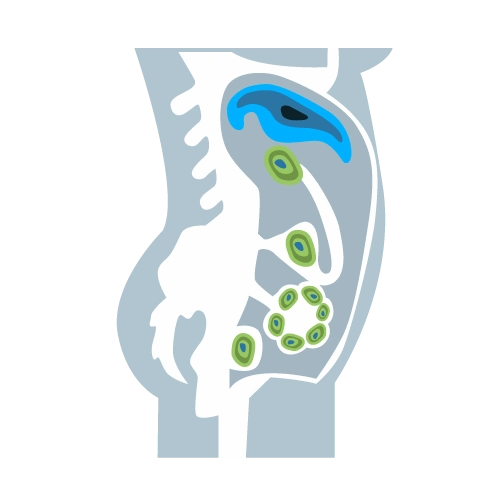 Carcinomatosis Peritoneal